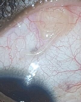 NEOflorax pomógł pozbyć się robaka w oku